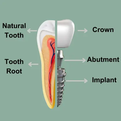 Dental implant Izmir